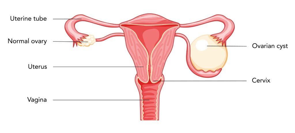 Diagram of an ovarian cyst